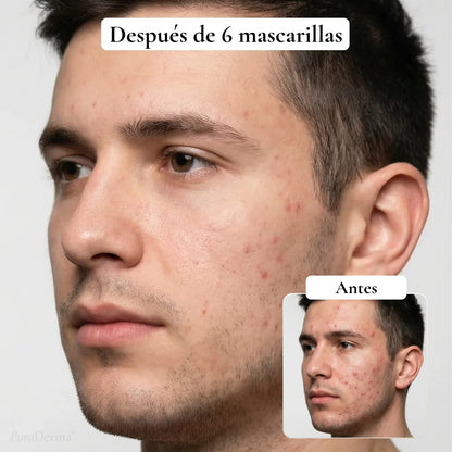 PuraDerma™ Mascarilla Hidrocoloide Anti-Imperfecciones Cobertura Total